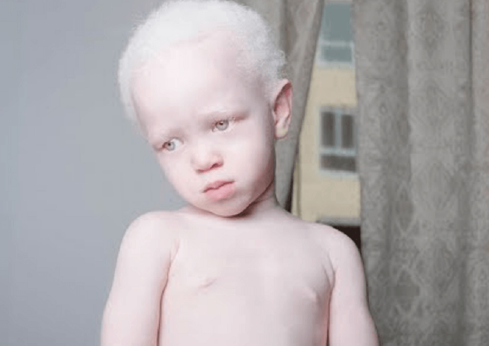 Crianças albinas são vítimas de bruxaria na Tanzânia.